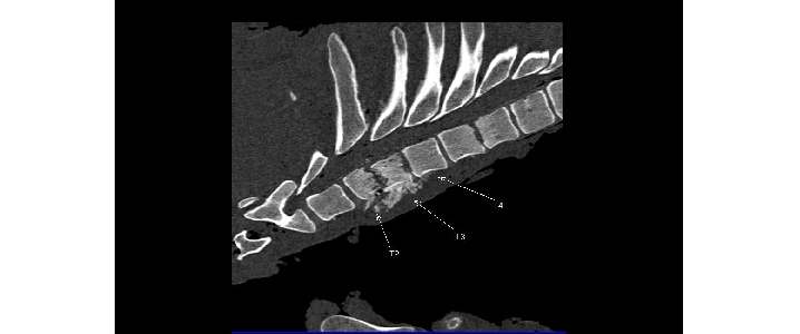Zminy zapalne trzonów kręgowych i krążków miedzykręgówych kręgów piersiowych od 2 do 4. Tomografia komputerowa, projekcja strzałkowa.
