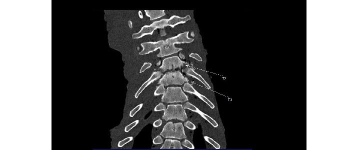 Zminy zapalne trzonów kręgowych i krążków miedzykkręgówych kręgów piersiowych od 2 do 4. Tomografia komputerowa,  projekcja grzbietowo brzuszna.